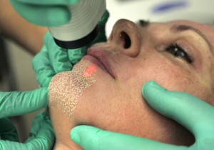 cosmetic_surgery_laser_resurfacing